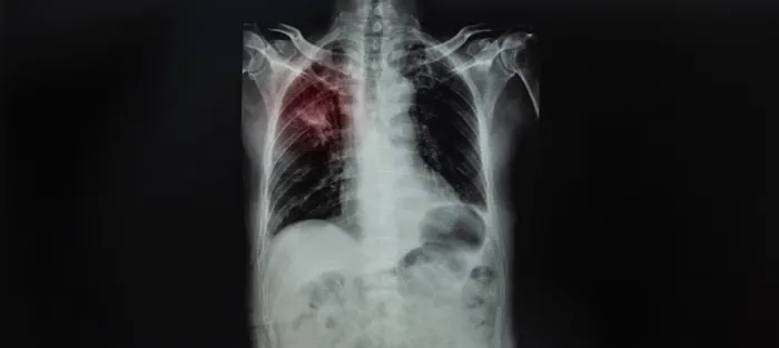 An x-ray of an engineered stone worker diagnosed with silicosis